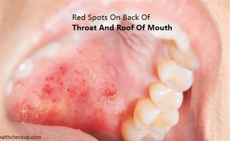 Strep Throat Red Spots On Back Of Throat And Roof Of Mouth Otosection