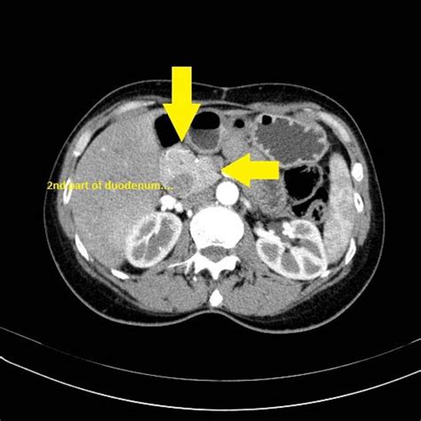 Annular Pancreas Is A Morphological Anomaly Which Can Grepmed