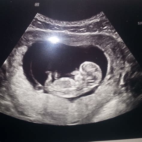 選択した画像 Weeks Pregnant Ultrasound Girl Weeks Sexiz Pix