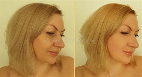 Woman Face Wrinkles Before And After Tension Revitalization Treatment