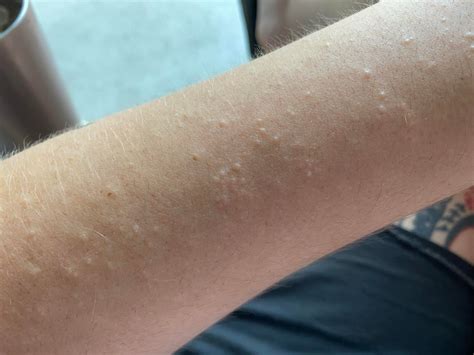 Clusters Of Small Bumps On My Arm Rdermatologyquestions