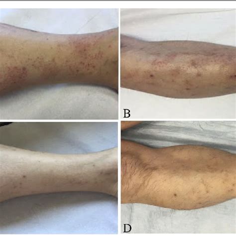 A B Diffuse Erythematous Maculaes And Papules On The Lower Extremities