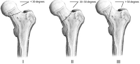 Femoral Neck Fractures Musculoskeletal Key