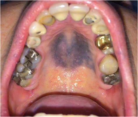Extensive Hard Palate Hyperpigmentation Associated With Chloroquine Use