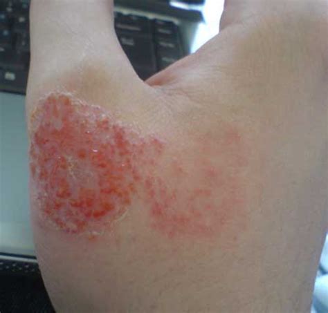 Mild Eczema Causes Symptoms Diagnoses Treatment Pictures