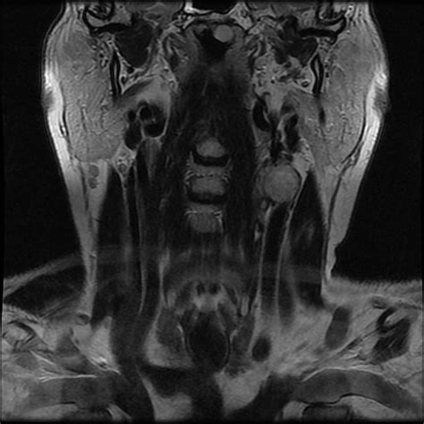 Left Carotid Body Paraganglioma Image