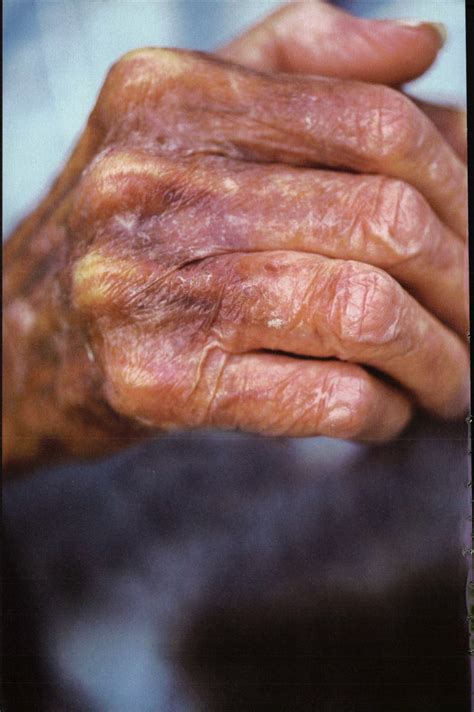 Hand Infection Associated with Clenched Fist Syndrome in Residents of Long-Term Care Facilities