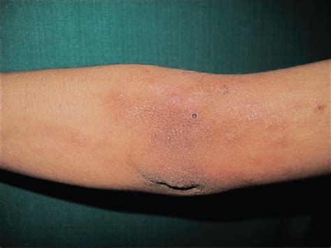 Isolated Unilateral Palisaded Neutrophilic And Granulomatous Dermatitis