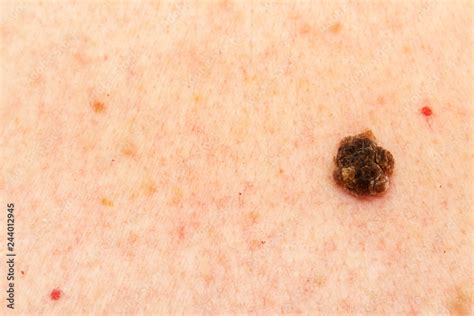 Seborrheic Keratosis Also Known As Seborrheic Verruca Or A Senile Sexiz Pix