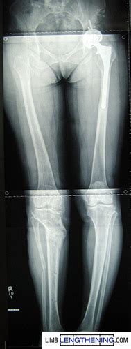 Tibial osteotomy for lengthening and straightening of ...