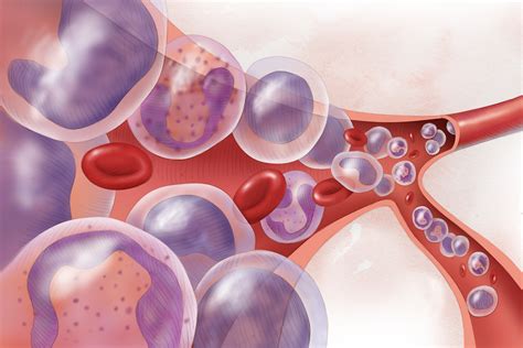 Flow Cytometry As A Relapse Risk Assessment Tool In T Cell Acute Lymphoblastic Leukemia