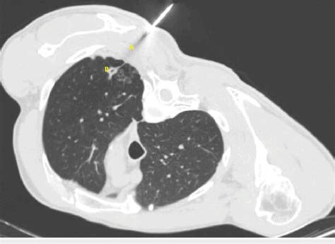 Transthoracic Needle Biopsy Axial Ct Scan Image Showing Posterior