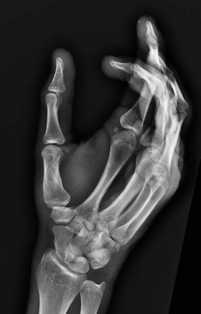 Hamate Fracture Classification Radiology Reference Article