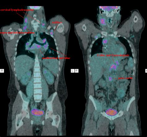 Pet Scan Machine Results Images Galleries With A Bite