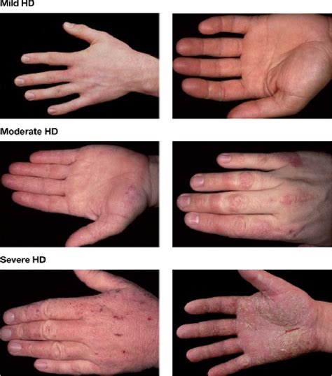 Figure 1 From Canadian Hand Dermatitis Management Guidelines Semantic