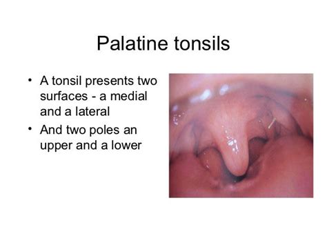 Acute Tonsillitis