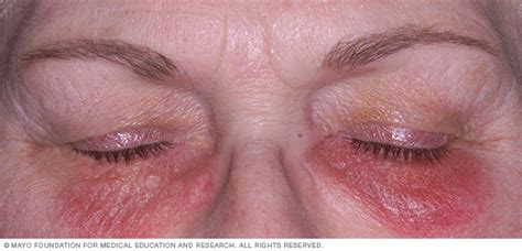 Dermatitis De Contacto Síntomas Y Tratamiento Medicina Básica