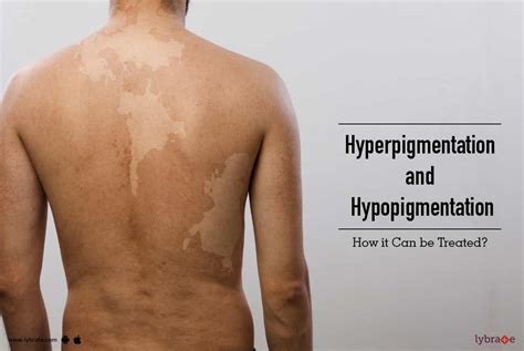 Hyperpigmentation And Hypopigmentation How It Can Be Treated By Dr
