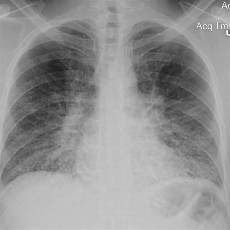 Frontal Chest Radiograph Shows Bilateral Perihilar And Centrally