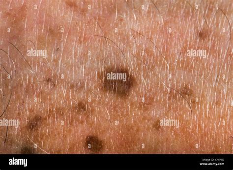 Age Spots Spot Skin Old Problem Cancer Spotted Close Up Closeup Makro