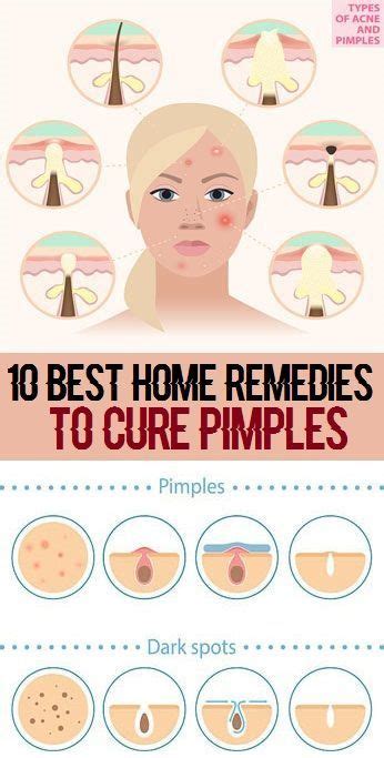 Whether Youre Worried About That Newly Arrived Pimple On Your Face