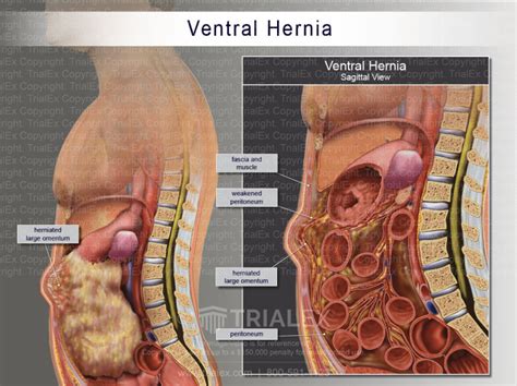Giant Abdominal Wall Hernia Hot Sex Picture