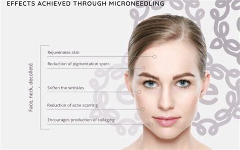 Is Microneedling Better Than Botox Elise Clinic