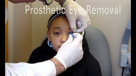 Artificial Eye Removal Youtube