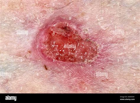 Basal Cell Carcinoma Skin Cancer Close Up Of An Ulcerated Infiltrative