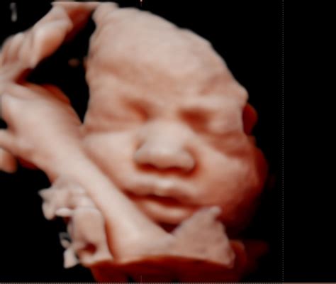 Gallery Babybump 3d4d Pregnancy Ultrasound