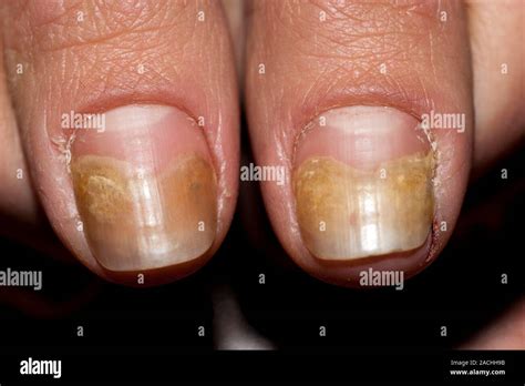 Fungal Nail Infection Toenails Of A Middle Aged Woman With