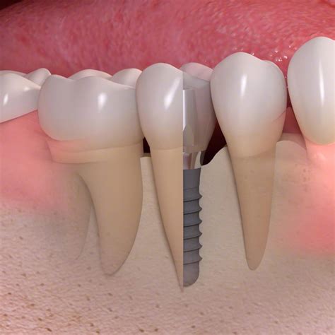 Implantes dentales de titanio Clínica Dental Sánchez del Campo Llanes