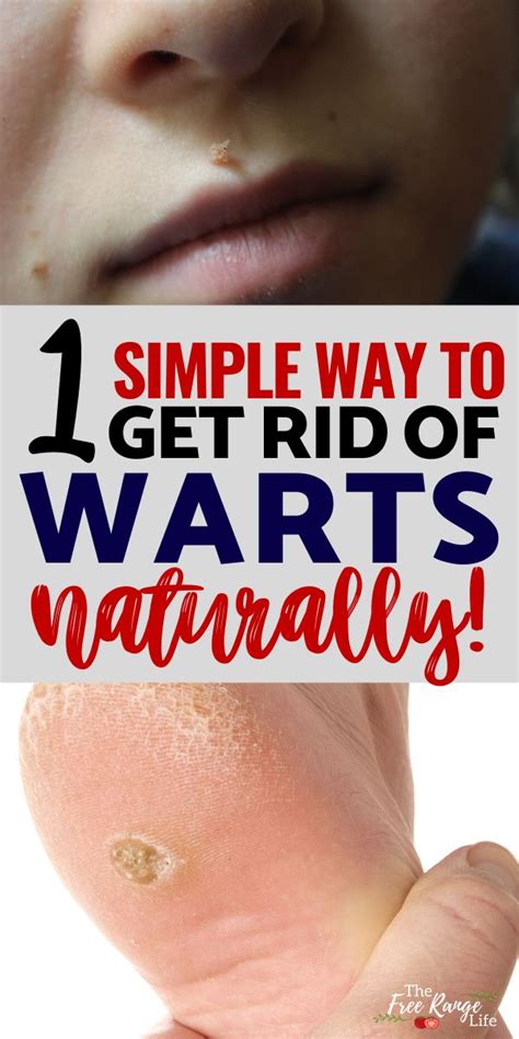 The Easiest Way To Get Rid Of Warts Naturally Get Rid Of Warts Wart
