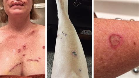 Some images are hidden because they can no longer be found or have been removed by the file host. Woman shares skin cancer photos to show effects of tanning ...
