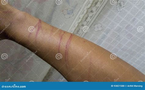 Cat Scratch On Your Skin Stock Photo Image Of Attack 93821588
