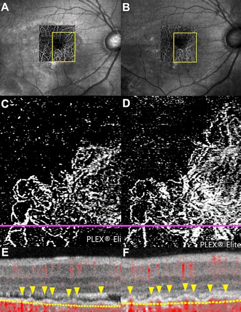 Change Of The Choroidal Neovascularization Detected In The Octa Images