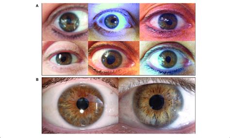 A Right Eye Of Patient 3 During Different Episodes Of Tadpole