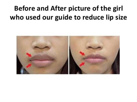 Reduce Lip Size Naturally Without Surgery