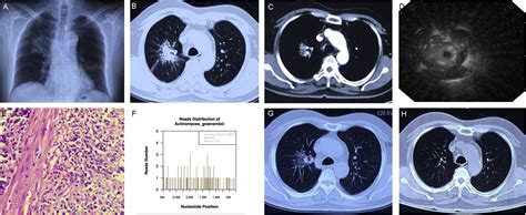 Pulmonary Actinomycosis Diagnosed By Radial Endobronchial Ultrasound