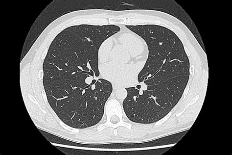Healthy Lung Ct Scan Images Ct Scan Machine