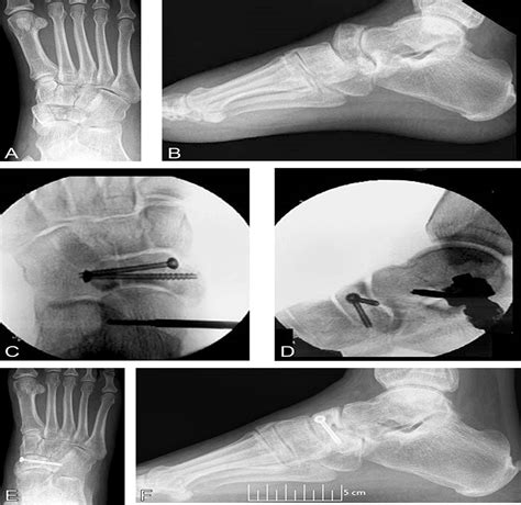 Navicular Body FracturesSurgical Treatment And Radiographic Journal Of Orthopaedic Trauma