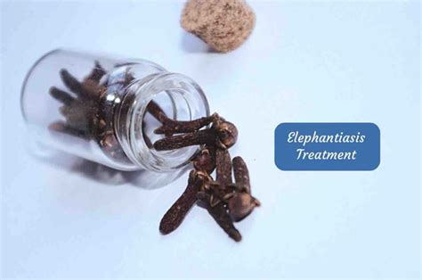 Elephantiasis Treatment Ayurvedum