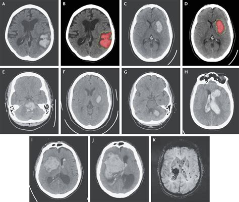 Spontaneous Intracerebral Hemorrhage Nejm