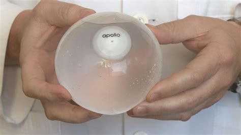 Avera Medical Minute Amck Orbera Intragastric Balloon Helps Patients