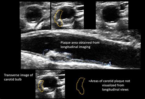 Sonographic Assessment Of Carotid Atherosclerosis Preferred Risk