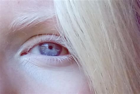 Пин на доске Albino Eyes глаза альбиноса