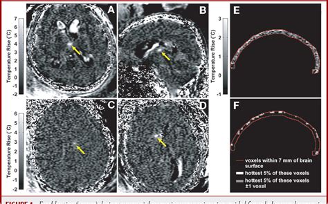 Figure 4 From Transcranial Magnetic Resonance Imaging Guided Focused