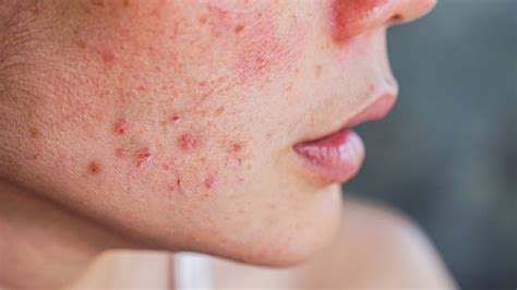 Discovernet The Ultimate Guide For Getting Rid Of Inflammatory Acne