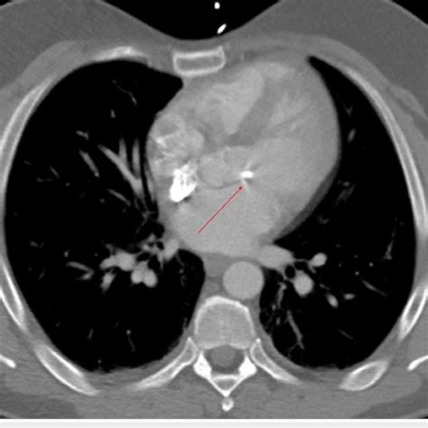 Ct Of The Chest Showing Calcification Of The Mitral Valve And No
