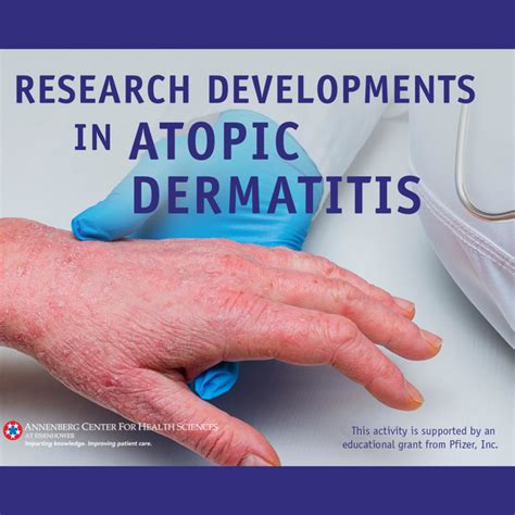 Research Developments In Atopic Dermatitis Podcast On Spotify